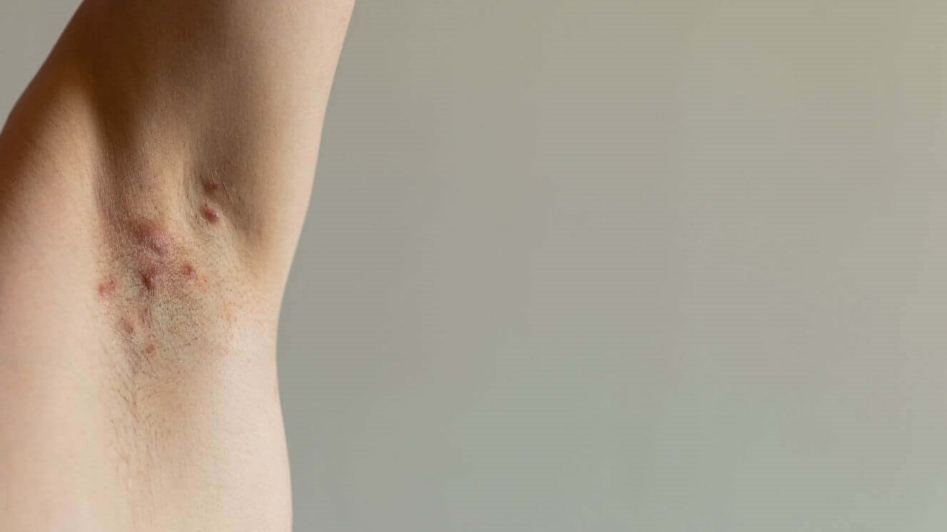 glp-1 eczema GLP-1s in Dermatology glp-1 eczema GLP-1s in Dermatology