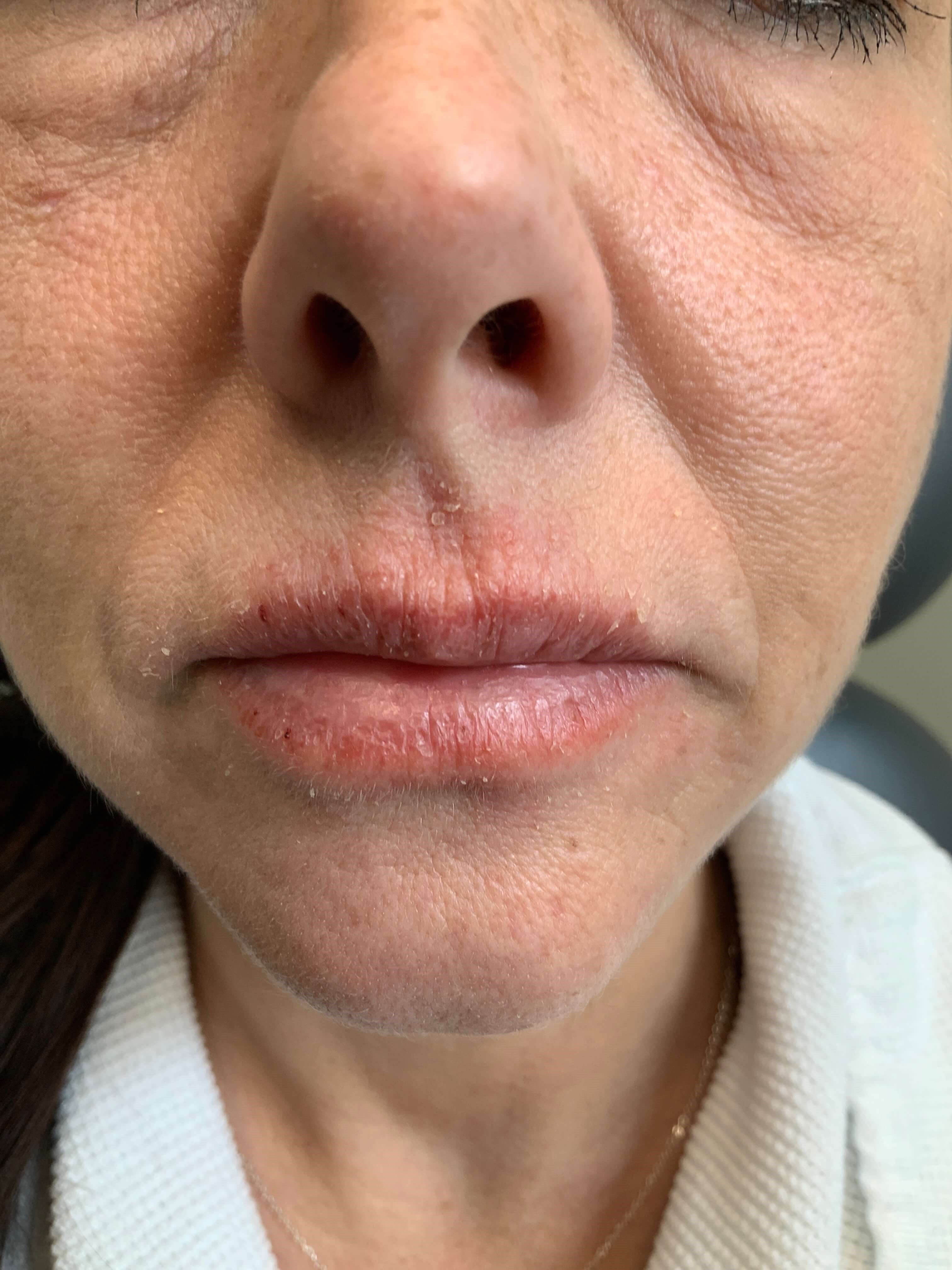 Before And After Eczema Rashes Photos