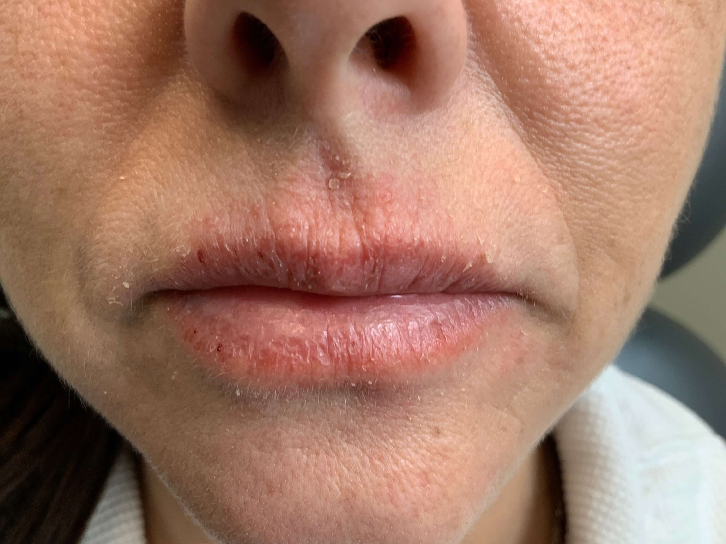 Before And After Eczema Rashes Photos
