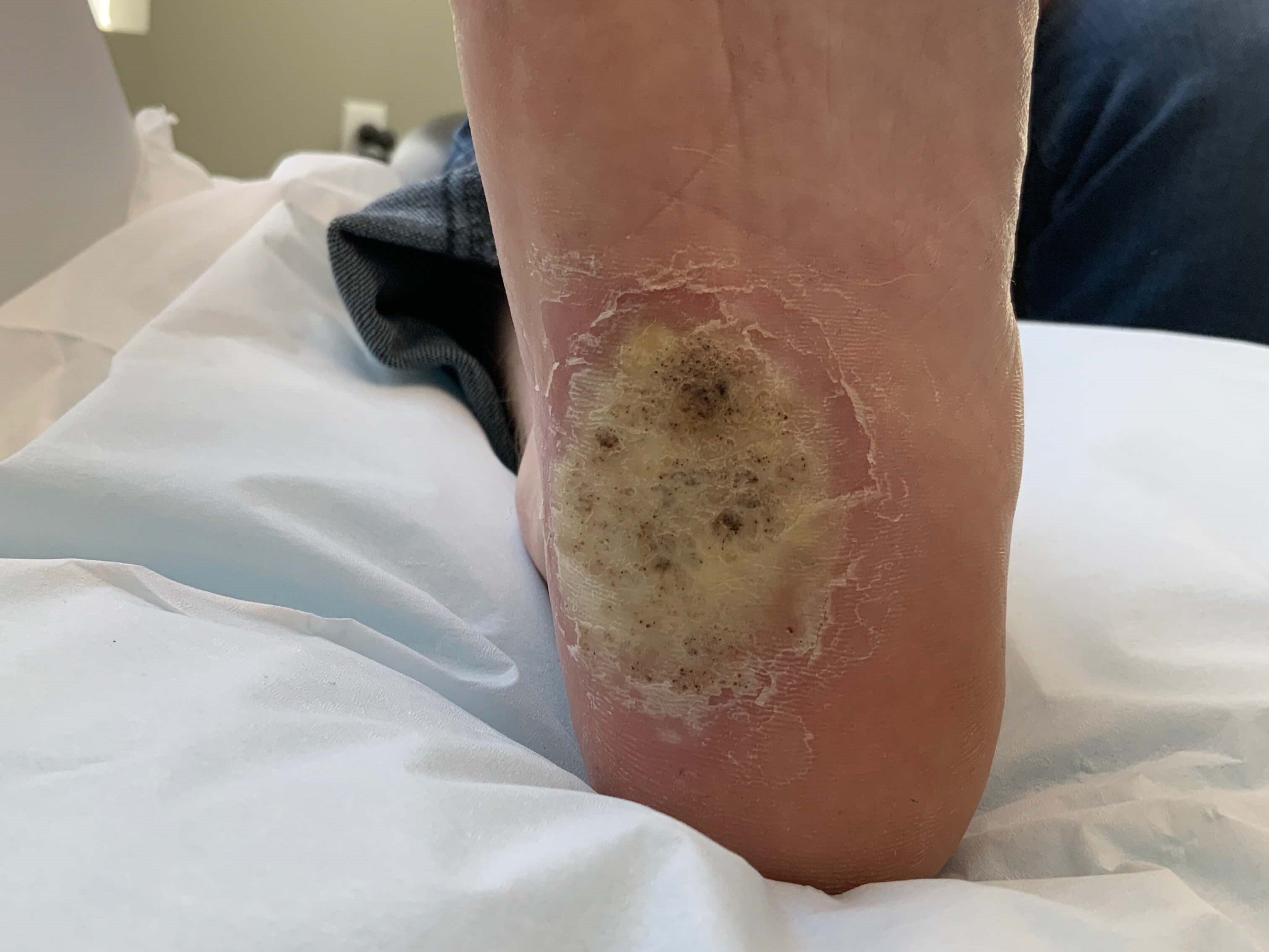 Before and After Cryosurgery & Warts & Electrodesiccation & Topical